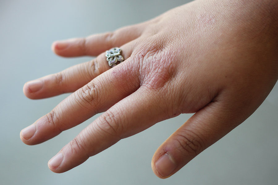 %22Learning+to+accept+I+have+eczema+has+been+tough+for+me%2C+and+like+my+love+for+rings+and+heels%2C+I%E2%80%99ve+learned+to+love+my+eczema+too.%22